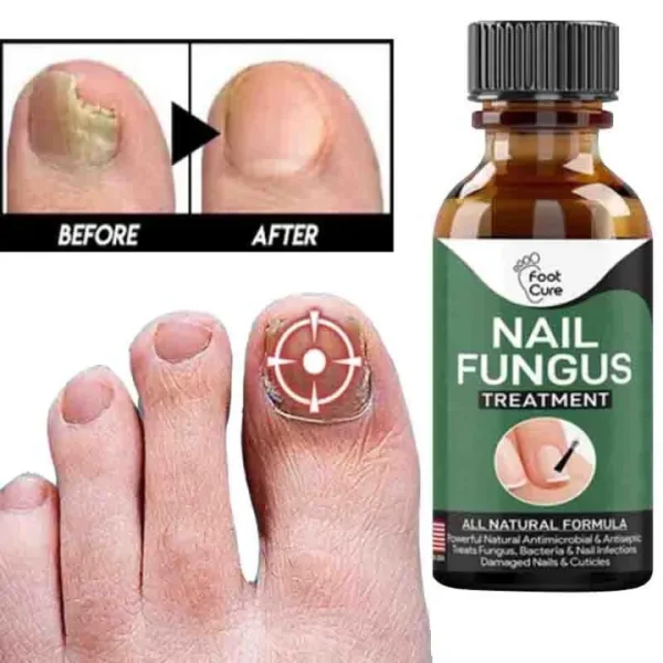 Fast Nail Fungal Treatment – Nail Repair Essence Serum (10ml)
